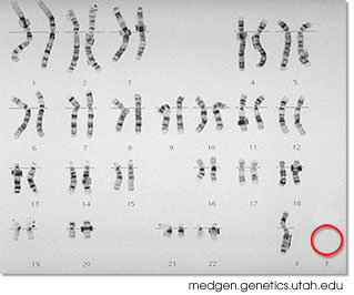 Karyotype of a female with Turner's Syndrome showing one X chromosome